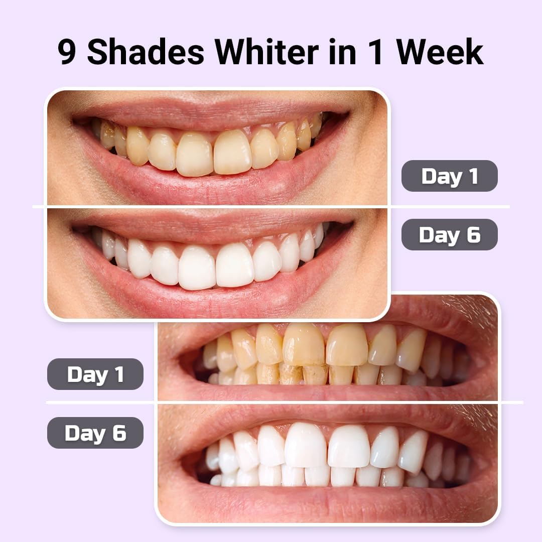 Puur Smile Teeth Whitening Kit – LED Light & Whitening Gel With Remineralization Syringes – Professional-Grade Whitening For Sensitive Teeth – Removes Stains From Coffee, Wine, & Smoking