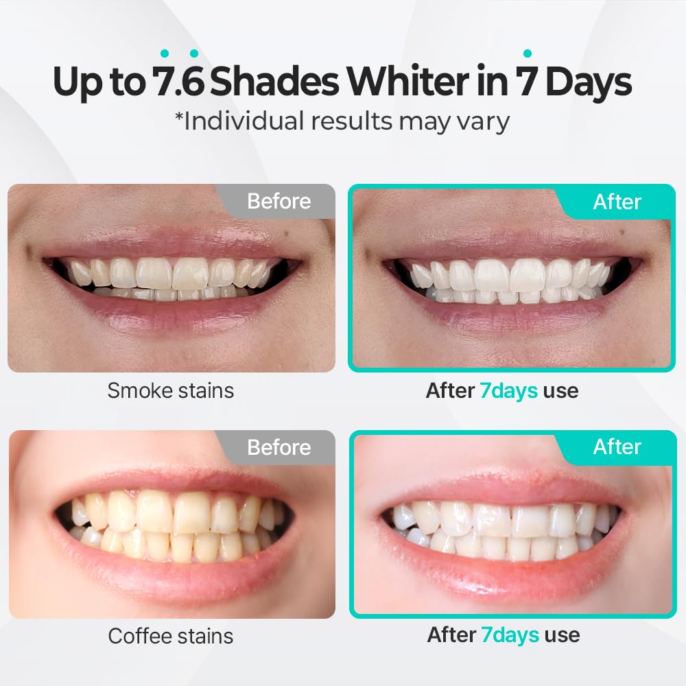 Precision, application control, and included accessories that support cleaner whitening sessions.